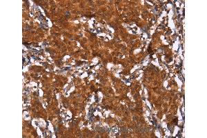Immunohistochemistry of Human thyroid cancer using HCAR2 Polyclonal Antibody at dilution of 1:40