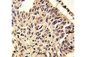 IHC analysis of FFPE human lung carcinoma stained with H4 antibody (HIST1H4A Antikörper  (meLys20))