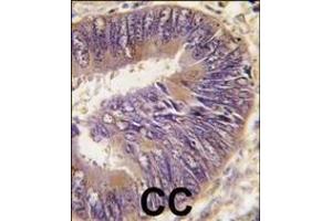 Formalin-fixed and paraffin-embedded human colon carcinoma tissue reacted with ST13 antibody (N-term), which was peroxidase-conjugated to the secondary antibody, followed by DAB staining. (HSC70 Interacting Protein HIP Antikörper  (AA 50-80))