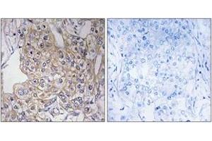 Immunohistochemistry analysis of paraffin-embedded human breast carcinoma tissue, using TNXB Antibody.