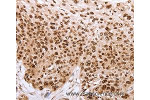 Immunohistochemistry of Human esophagus cancer using PARP1 Polyclonal Antibody at dilution of 1:40 (PARP1 Antikörper)
