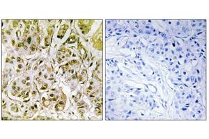 Immunohistochemistry analysis of paraffin-embedded human breast carcinoma tissue, using Smad1 (Phospho-Ser187) antibody. (SMAD1 Antikörper  (pSer187))