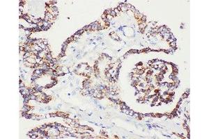 IHC-P: Peroxiredoxin 5 antibody testing of human prostatic cancer tissue (Peroxiredoxin 5 Antikörper  (C-Term))