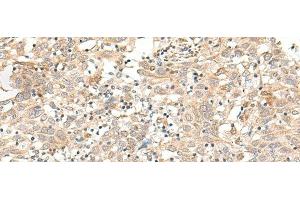 Immunohistochemistry of paraffin-embedded Human cervical cancer tissue using FUT3 Polyclonal Antibody at dilution of 1:35(x200) (FUT3 Antikörper)