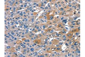 The image on the left is immunohistochemistry of paraffin-embedded Human liver cancer tissue using ABIN7130906(RNF7 Antibody) at dilution 1/20, on the right is treated with fusion protein.
