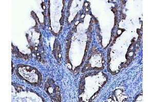 IHC analysis of TRK fused gene/TFG using anti-TRK fused gene/TFG antibody (ABIN7599839). (TFG Antikörper  (AA 121-400))
