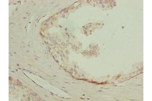 Immunohistochemistry of paraffin-embedded human prostate cancer using ABIN7158732 at dilution of 1:100 (LYSMD1 Antikörper  (AA 1-227))