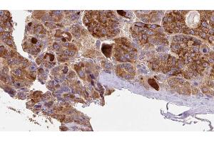 ABIN6273892 at 1/100 staining Human liver cancer tissue by IHC-P. (GPR77 Antikörper  (C-Term))