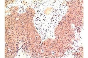 Immunohistochemical analysis of paraffin-embedded Human Colon Carcinoma Tissue using Epsilon Tubulin Mouse mAb diluted at 1:200. (TUBE1 Antikörper)