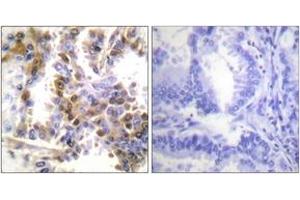 Immunohistochemistry analysis of paraffin-embedded human lung carcinoma tissue, using 4E-BP1 (Ab-36) Antibody. (eIF4EBP1 Antikörper  (AA 2-51))