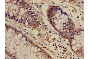 Immunohistochemistry of paraffin-embedded human colon cancer using ABIN7175830 at dilution of 1:100 (WASF1 Antikörper  (AA 381-553))