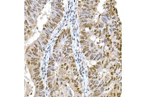 Immunohistochemistry of paraffin-embedded human colon carcinoma using Snail Rabbit pAb (ABIN1682836, ABIN3019402, ABIN3019403, ABIN3019404 and ABIN6220883) at dilution of 1:150 (40x lens).
