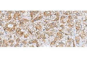 Immunohistochemistry of paraffin-embedded Human liver cancer tissue using NQO2 Polyclonal Antibody at dilution of 1:70(x200) (NQO2 Antikörper)