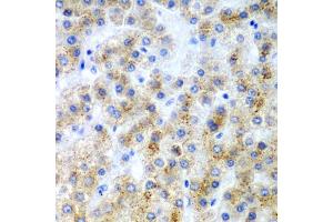 Immunohistochemistry of paraffin-embedded human liver cancer using LY86 antibody. (LY86 Antikörper)