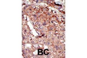 Formalin-fixed and paraffin-embedded human cancer tissue reacted with BRD2 polyclonal antibody  , which was peroxidase-conjugated to the secondary antibody, followed by AEC staining. (BRD2 Antikörper  (Internal Region))