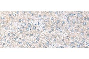Immunohistochemistry of paraffin-embedded Human liver cancer tissue using FARP2 Polyclonal Antibody at dilution of 1:70(x200) (FARP2 Antikörper)