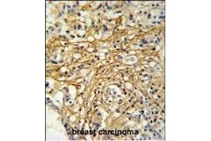 DC13 Antibody (N-term) (ABIN651108 and ABIN2840074) IHC analysis in formalin fixed and paraffin embedded human breast carcinoma followed by peroxidase conjugation of the secondary antibody and DAB staining. (C16orf61 Antikörper  (N-Term))