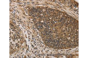 Immunohistochemistry of Human colon cancer using DACH1 Polyclonal Antibody at dilution of 1:50 (DACH1 Antikörper)