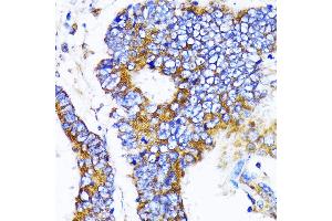 Immunohistochemistry of paraffin-embedded human colon carcinoma using MRPL13 antibody  at dilution of 1:100 (40x lens). (MRPL13 Antikörper  (AA 1-179))