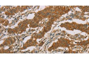 Immunohistochemistry of paraffin-embedded Human gasrtic cancer tissue using CYP39A1 Polyclonal Antibody at dilution 1:50 (CYP39A1 Antikörper)