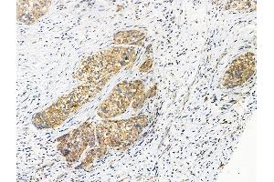 Phospho-Transferrin Receptor (Tyr20) Antibody at 1/100 staining Human ovarian cancer by IHC-P.