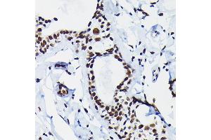 Immunohistochemistry of paraffin-embedded human breast cancer using HDGF Rabbit pAb  at dilution of 1:50 (40x lens). (HDGF Antikörper  (AA 1-240))