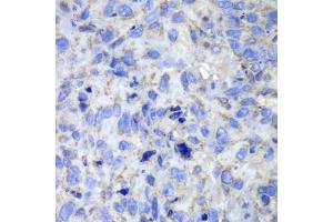 Immunohistochemistry of paraffin-embedded human lung cancer using CASP7 antibody (ABIN5970716) at dilution of 1/100 (40x lens). (Caspase 7 Antikörper)