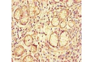 Immunohistochemistry of paraffin-embedded human gastric cancer using ABIN7144126 at dilution of 1:100 (ACE2 Antikörper  (AA 395-638))