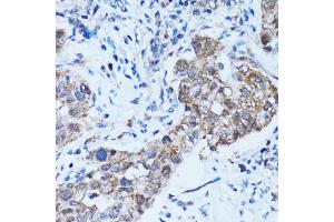 Immunohistochemistry of paraffin-embedded human lung cancer using CASP3 antibody (ABIN5997372) at dilution of 1/100 (40x lens). (Caspase 3 Antikörper)