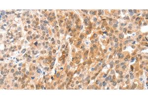 Immunohistochemistry of paraffin-embedded Human esophagus cancer using ANXA8 Polyclonal Antibody at dilution of 1:35 (Annexin VIII Antikörper)