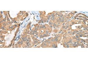 Immunohistochemistry of paraffin-embedded Human thyroid cancer tissue using CA6 Polyclonal Antibody at dilution of 1:35(x200) (CA6 Antikörper)