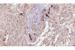 ABIN6274983 at 1/100 staining Human Melanoma tissue by IHC-P. (CGREF1 Antikörper  (C-Term))