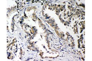 Anti-PLK2 antibody, IHC(P) IHC(P): Human Lung Cancer Tissue (PLK2 Antikörper  (C-Term))