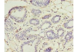 Immunohistochemistry of paraffin-embedded human breast cancer using ABIN7174434 at dilution of 1:100 (UBE2D1 Antikörper  (AA 1-147))