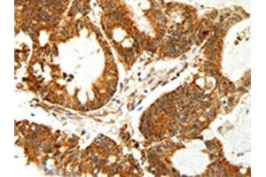 The image on the left is immunohistochemistry of paraffin-embedded Human colon cancer tissue using ABIN7129018(COX7B Antibody) at dilution 1/60, on the right is treated with fusion protein.
