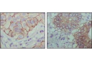 Immunohistochemical analysis of paraffin-embedded human lung cancer (left) and colon cancer (right) showing cytoplasmic localization with DAB staining using EphB1 mouse mAb. (EhpB1 (AA 19-133) Antikörper)