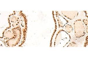 Immunohistochemistry of paraffin-embedded Human thyroid cancer tissue using RMND5B Polyclonal Antibody at dilution of 1:50(x200) (RMND5B Antikörper)