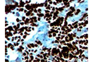 Immunohistochemical analysis of MYOG in a frozen tissue section of human alveolar rhabdomyosarcoma.