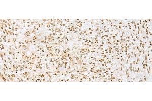 Immunohistochemistry of paraffin-embedded Human liver cancer tissue using PNRC2 Polyclonal Antibody at dilution of 1:30(x200) (PNRC2 Antikörper)