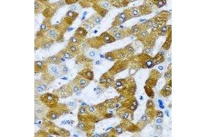 Immunohistochemical analysis of AARS2 staining in human liver cancer formalin fixed paraffin embedded tissue section. (AARS2 Antikörper)