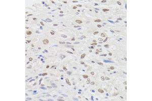 Immunohistochemistry of paraffin-embedded human lung cancer using HMGN1 antibody (ABIN5975005) at dilution of 1/100 (40x lens). (HMGN1 Antikörper)