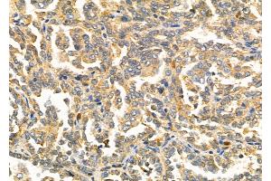 ABIN6257757 and ABIN6275874 at 1/100 staining Human kidney cancer by IHC-P. (LY75/DEC-205 Antikörper  (Internal Region))