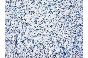 Immunohistochemical staining of paraffin-embedded Adenocarcinoma of breast tissue using anti-PRKY mouse monoclonal antibody. (PRKY Antikörper)