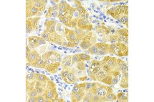 Immunohistochemistry of paraffin-embedded human liver cancer using CYP2E1 antibody at dilution of 1:100 (x400 lens). (CYP2E1 Antikörper)