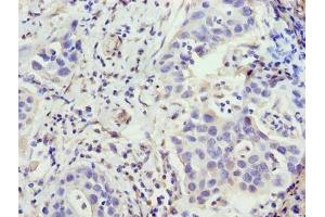 Immunohistochemistry of paraffin-embedded human bladder cancer using ABIN7176493 at dilution of 1:100 (ZNF643 Antikörper  (AA 15-310))