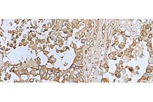 Immunohistochemistry of paraffin-embedded Human colorectal cancer tissue using TREM1 Polyclonal Antibody at dilution of 1:50(x200) (TREM1 Antikörper)