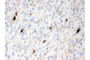 Alpha Internexin was detected in paraffin-embedded sections of human glioma tissues using rabbit anti- Alpha Internexin Antigen Affinity purified polyclonal antibody (Catalog # ) at 1 µg/mL.