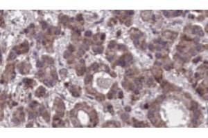 ABIN6273905 at 1/100 staining Human liver cancer tissue by IHC-P. (GPR97 Antikörper  (N-Term))