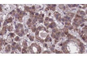 ABIN6273905 at 1/100 staining Human liver cancer tissue by IHC-P.