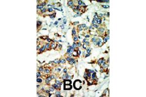 Formalin-fixed and paraffin-embedded human cancer tissue reacted with NEK4 polyclonal antibody  , which was peroxidase-conjugated to the secondary antibody, followed by AEC staining. (NEK4 Antikörper  (C-Term))